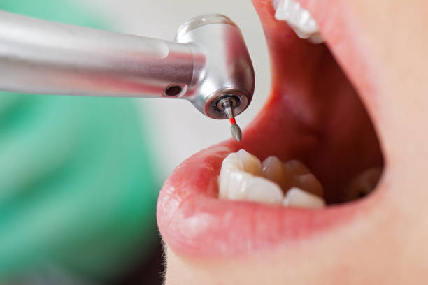 Best Knocked-Out Tooth (Avulsed Tooth) Treatment in Sandwich, IL